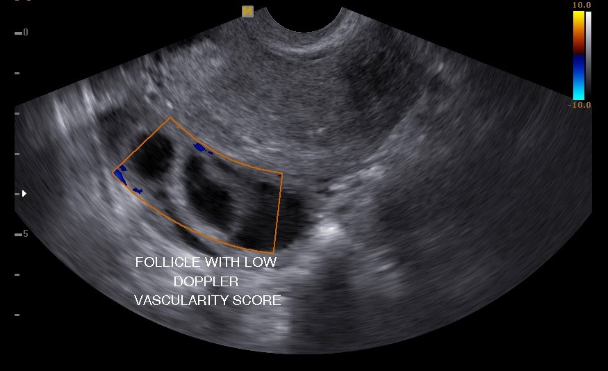 Ovulation Induction